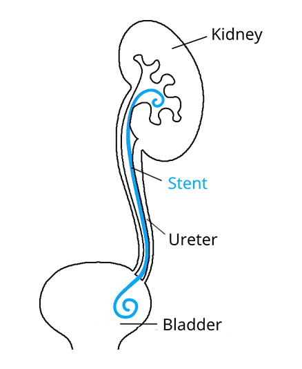 Ureteral Stent