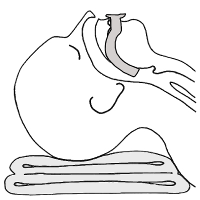 Oropharyngeal airway